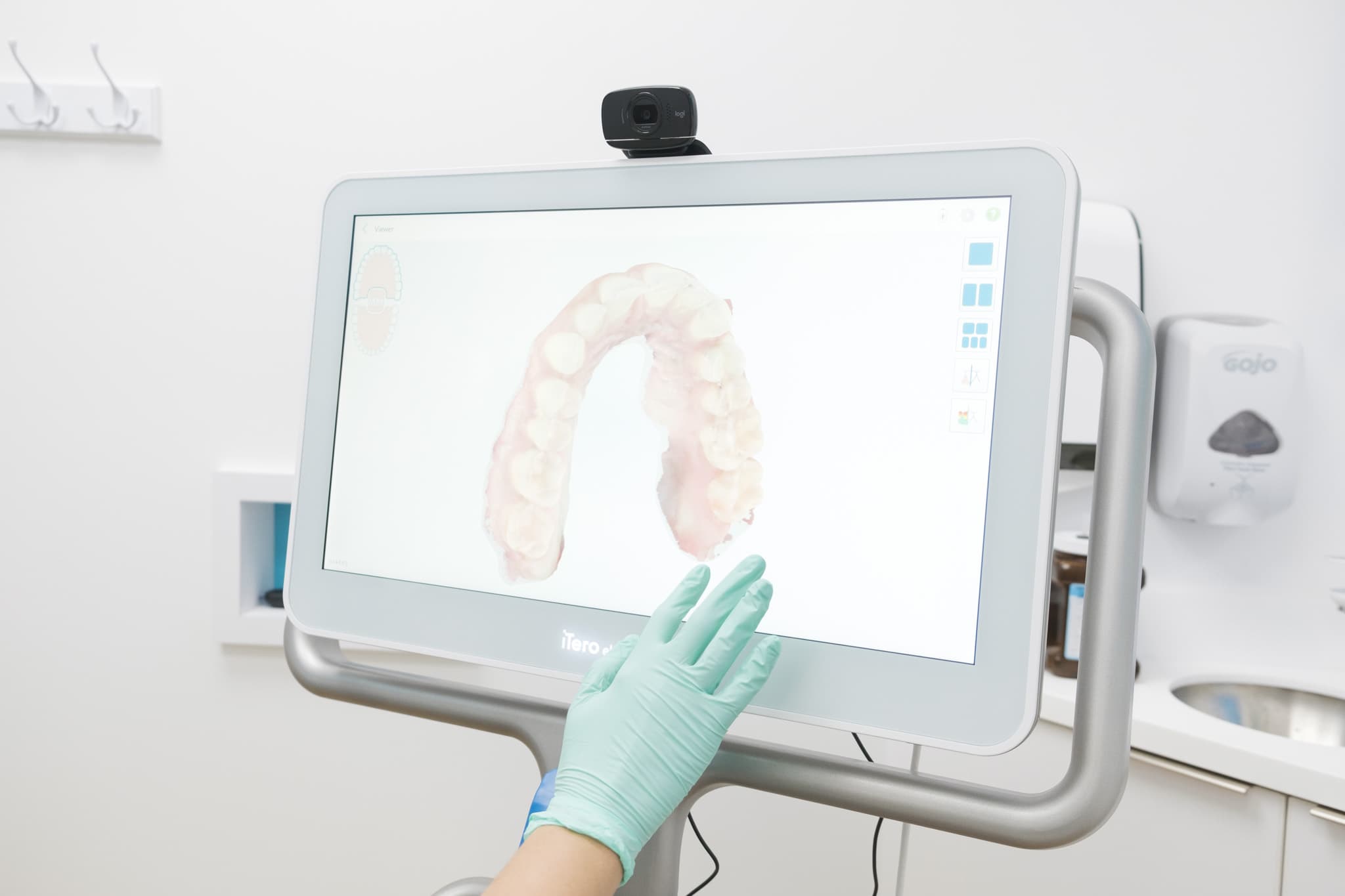 iTero 3D scan used for Invisalign treatment planning