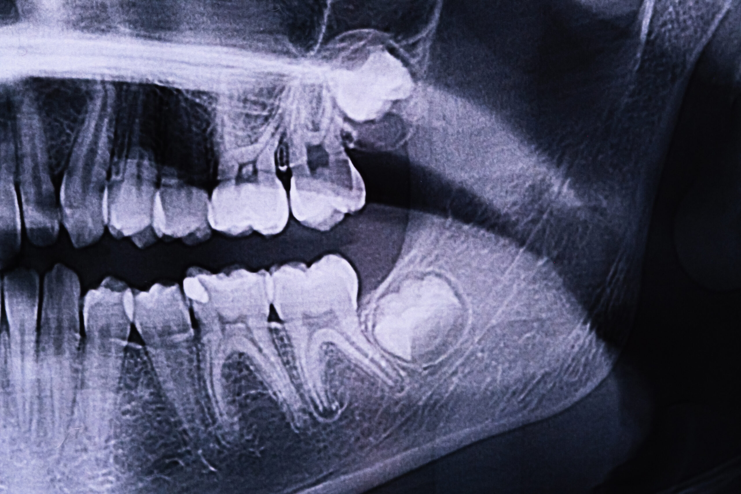 Panoramic dental X-ray used to evaluate wisdom teeth